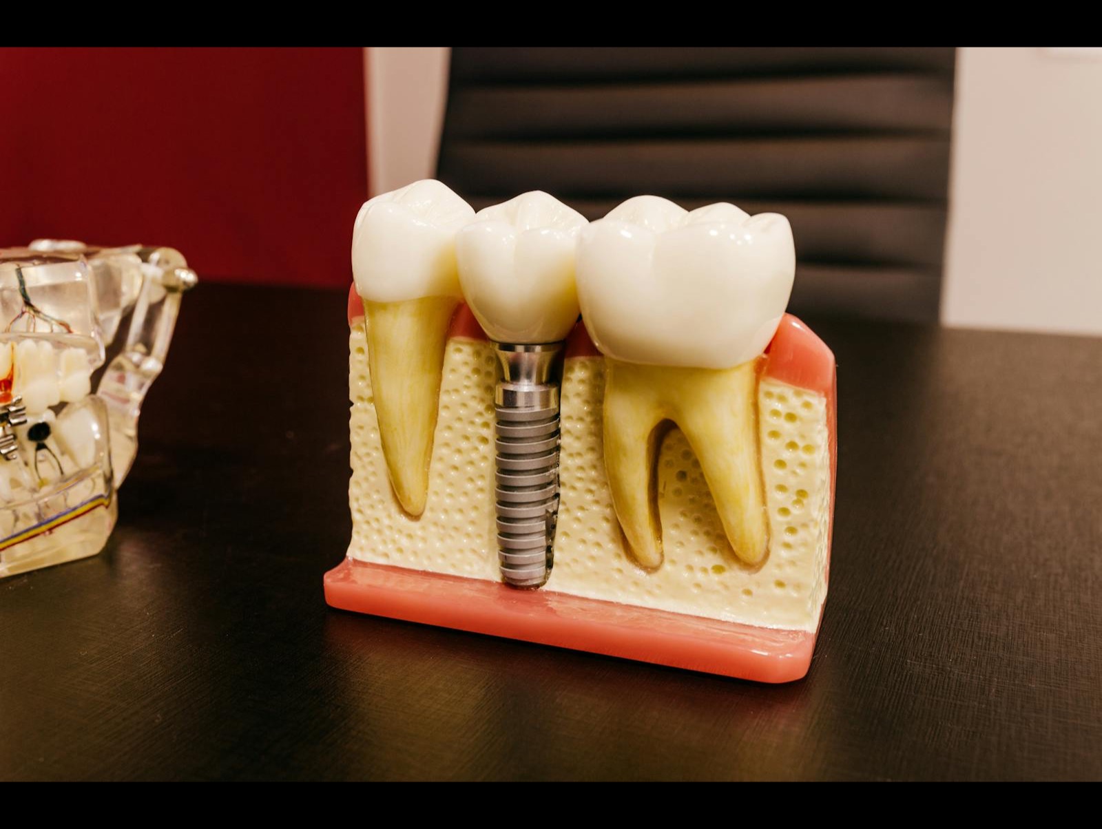 Keramik-Implantat mit Aufbau-Schraube — Premium-Implantatsystem