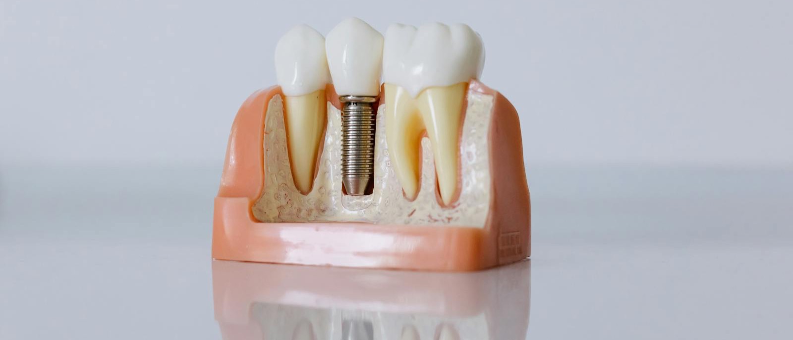 Anatomisches Modell - Zahn mit Implantat-Verankerung